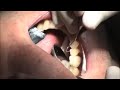 CEREC Cementation