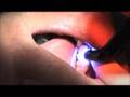 CEREC Cementation