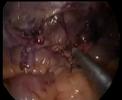 Appendectomy