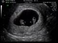 First ultrasound - it's triplets!