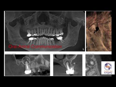 how to treat a periapical and a apex abscess on tooth