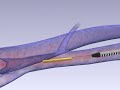 Laser Vein Treatment with the NeverTouch Fiber with VenaCure EVLT