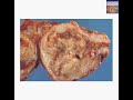 Histopathology Uterus, endometrium--Adenocarcinoma