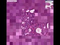 Histopathology Uterus, endometrium--Adenocarcinoma