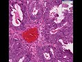 Histopathology Uterus, endometrium--Adenocarcinoma