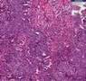 Histopathology Uterus, endometrium--Adenocarcinoma
