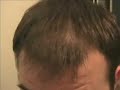 Hair regrowth