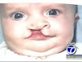Cleft Palate