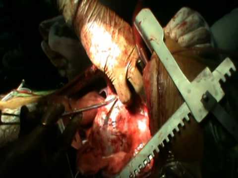 how to treat atheromatous aorta