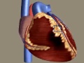 Myocardial Infarction