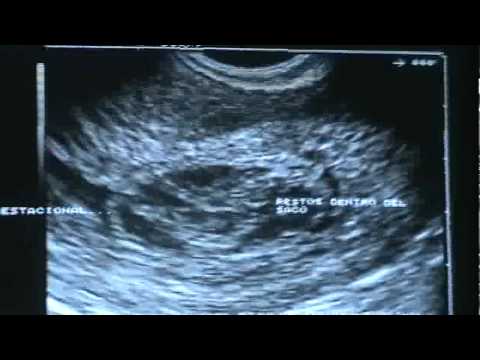 Retained Abortion- Miscarriage