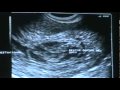 Retained Abortion- Miscarriage
