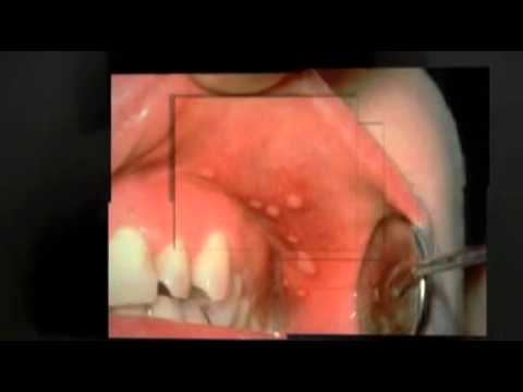 how to control oral herpes