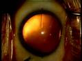 videos de Toric ICL surgery (Erik Martens)