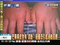 蕁麻疹