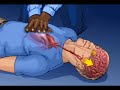 Continuous Chest Compression CPR Continuous Chest Compression CPR