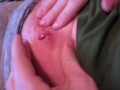 Bos' Ingrown Hair
