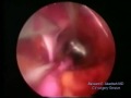 \"VasoView\" Endoscopic Saphenous Vein Harvesting \"VasoView\" Endoscopic Saphenous Vein Harvesting