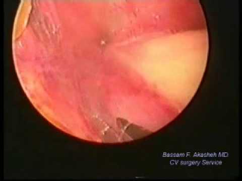 how to harvest a saphenous vein