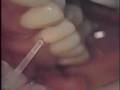Class V Composite ErYAG Laser Lite Touch