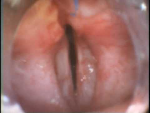 True vocal cords were paralyzed bilaterally preoperatively.