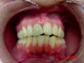 Invisalign Before and After of Dr David Galler www.premierdentalassociates.com