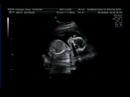 ultra sound