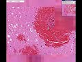 Histopathology Brain --Hemorrhage Histopathology Brain --Hemorrhage
