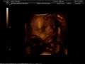 4D Scan of Baby Gough 28 weeks 4D Scan of Baby Gough 28 weeks