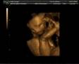 4D Scan of Baby Gough 28 weeks