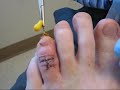 Hammer Toe Surgery