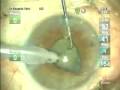 Catarata - IFIS Sindrome Iris Flacido Intraoperatorio Catarata - IFIS Sindrome Iris Flacido Intraoperatorio