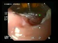 Barrett's Esophagus - Halo 90 Endoscopic Therapy Barrett's Esophagus - Halo 90 Endoscopic Therapy