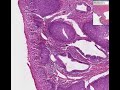 Histopathology Cervix --Squamous metaplasia & carcinoma-in-s