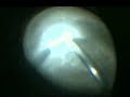 Stage 4a Retinopathy of Prematurity Lens Sparing Vitrectomy