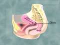 Video Prevención del Cancer de Cervix