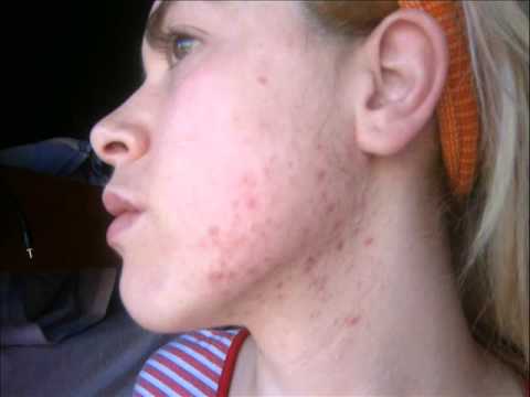 MI EXPERIENCIA CON EL ACNE
