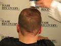 Fibras Capilares Hair Recovery - Cabello en Segundos 1