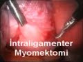 Laparoscopic Intraligamentous myomectomy