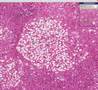 Histopathology Liver--Alcoholic liver disease