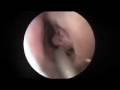 Turbinate Reduction: Surgeon's Perspective