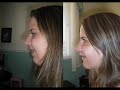 My orthognathic surgery, an update.