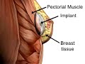 T.U.B.A Breast Augmentation - Transumbilical T.U.B.A Breast Augmentation - Transumbilical