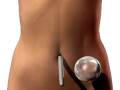 T.U.B.A Breast Augmentation - Transumbilical