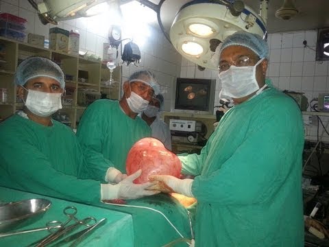 Huge intra-abdominal cyst with daughter cysts inside, cystectomy by laparotomy – Dr Narotam Dewan