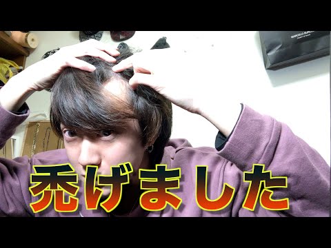 髪 分け目 ハゲ