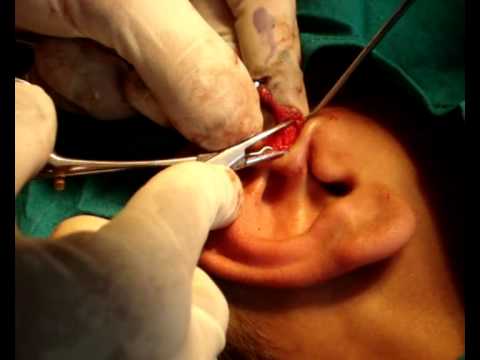 how to drain preauricular pit