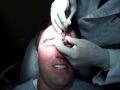 Forehead CYST Removal Surgery