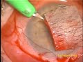 Trabeculectomy Left eye