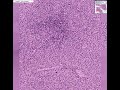Histopathology Lymph node--Peripheral T-cell lymphoma, unspe